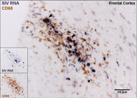 SIV-infected macrophages comprise lesions in the frontal cortex of an SIV-infected rhesus macaque that developed AIDS with SIV-associated encephalitis.